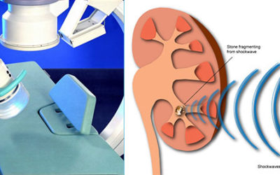 Leczenia Kamicy Nerkowej